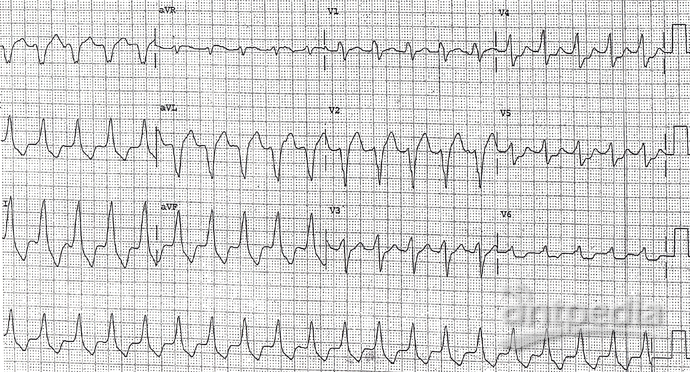 ht_200602_ventricular_tachycardia_podrid_ECG_10_690x397.png