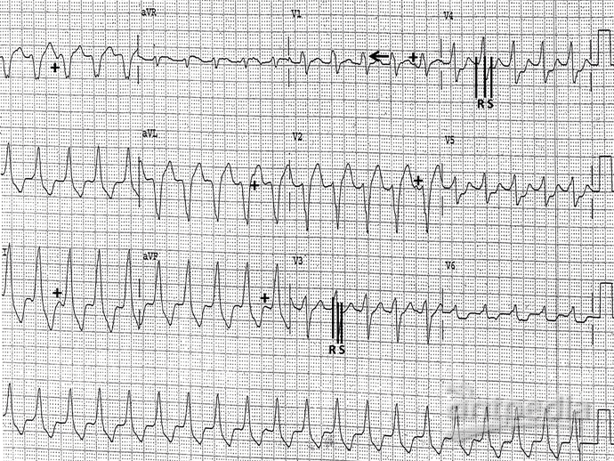 ht_200602_ventricular_tachycardia_podrid_ECG_10-labeled_690x543.png