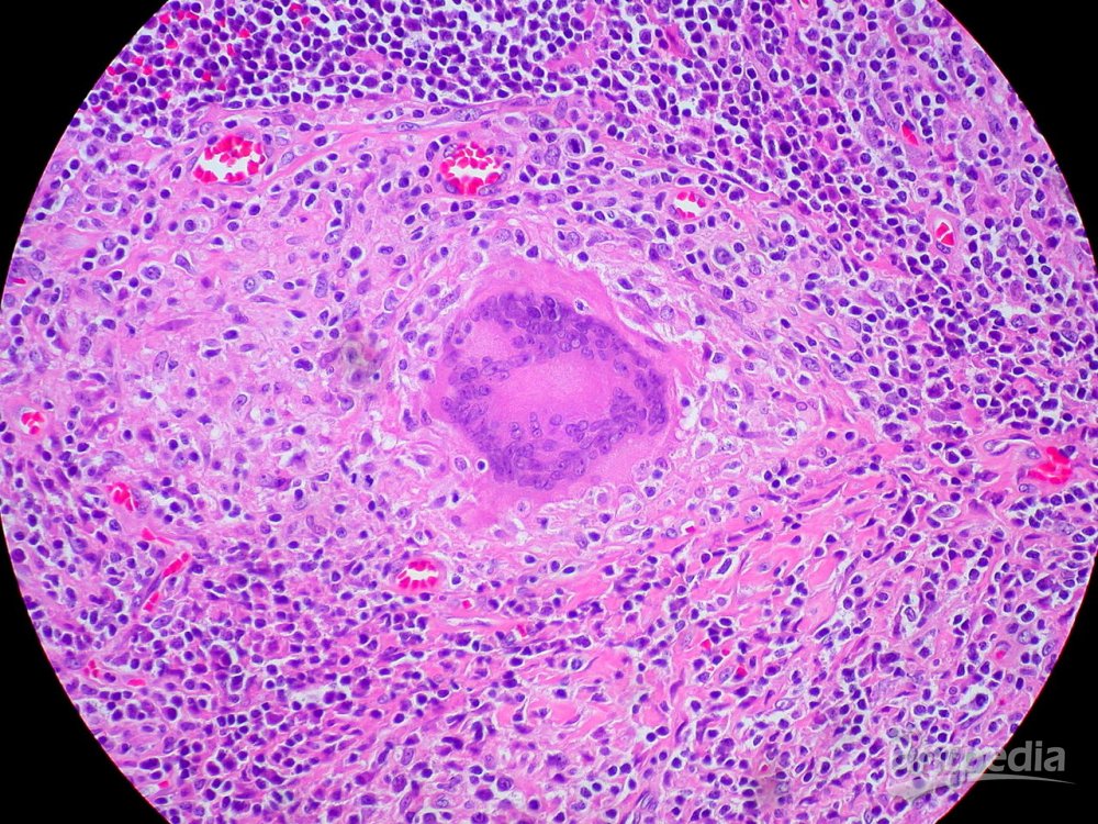 朗罕氏巨细胞(图1)