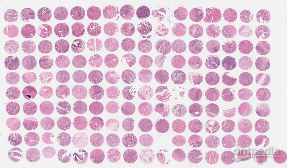 乳腺癌生存期组织芯片（BRC15015）